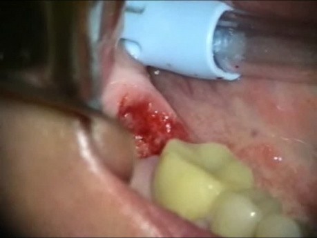 Immediate Molar Implant