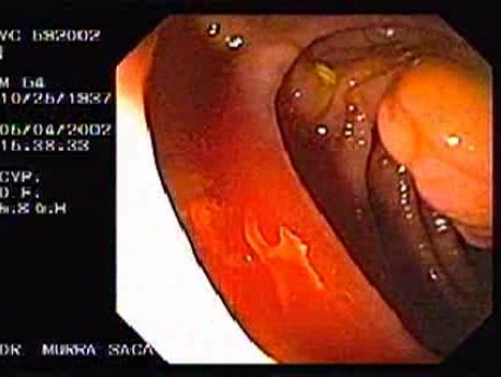 Cecum (1 of 2)