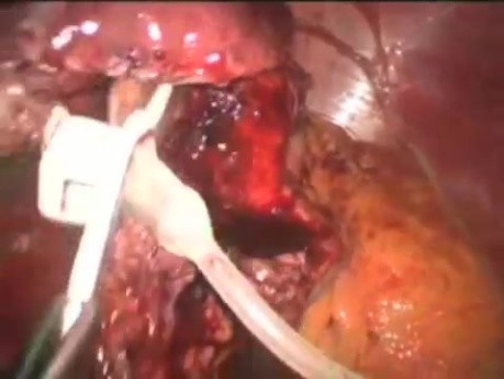 Revision Bariatrics: Band to Sleeve - SILS 