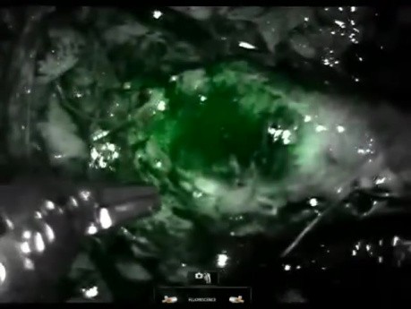 Buccal Mucosa Ureteroplasty and Ureteral Re-implant Surgery