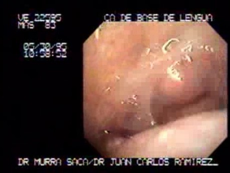 Carcinoma of the Base if the Tongue