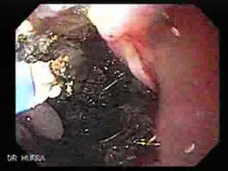 Adenocarcinoma of the Cardia and Carcinoma Epidermoid of the Larynx (21 of 26)