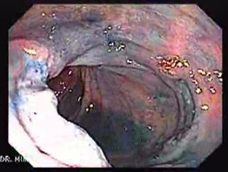 Colonic Tuberculosis Mimicking Crohn's Disease (7 of 12)
