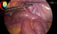 Huge Right Direct Inguinal Hernia