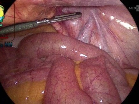 Huge Right Direct Inguinal Hernia