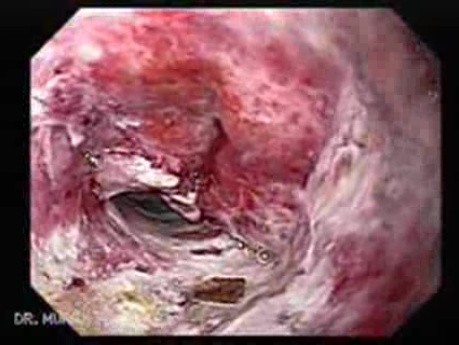 Adenocarcinoma of the Gastroesophageal Junction - Esophagus-Hernia Fistula, Part 2