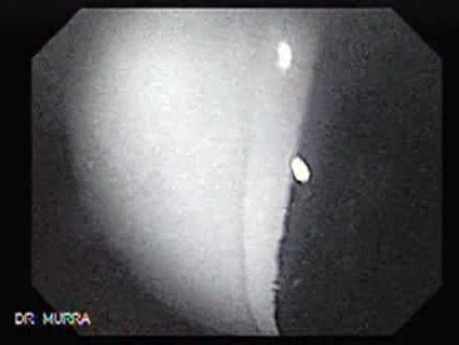 Intragastric Balloon - The Treatment Of Obesity (8 of 13)