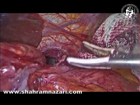 Laparoscopic Management of Totally Intra-Thoracic Stomach