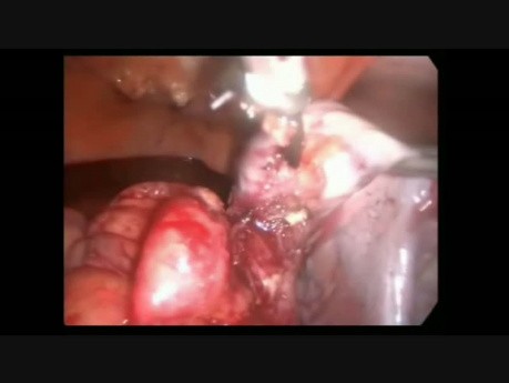 Lap Abdominal EP