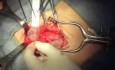 Inguinal hernia repair with mesh