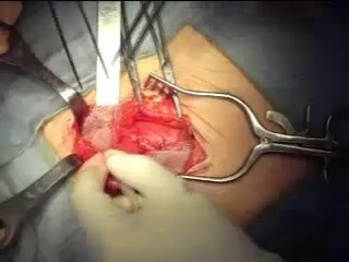 Inguinal hernia repair with mesh
