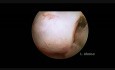 Hysteroscopic Myomectomy