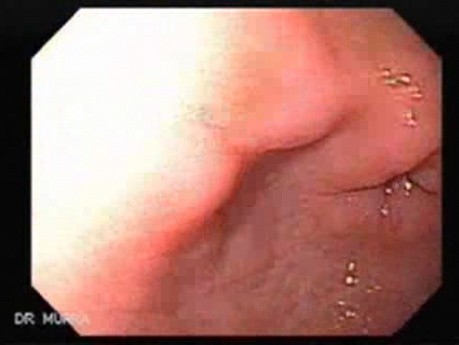 Intestinal Metaplasia