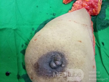 Same Breast After Neoadjuvant Chemoradiotherpy