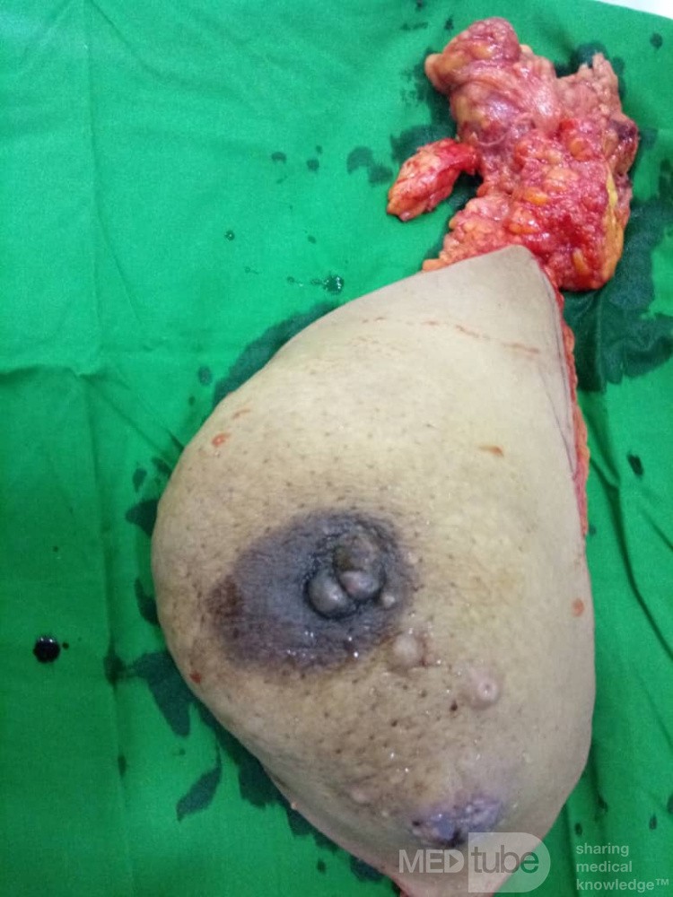Same Breast After Neoadjuvant Chemoradiotherpy