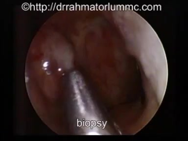 Postnasal Space Tumour Biopsy