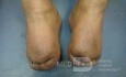 Bilateral Trans Metatarsal Amputation 