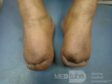 Bilateral Trans Metatarsal Amputation 