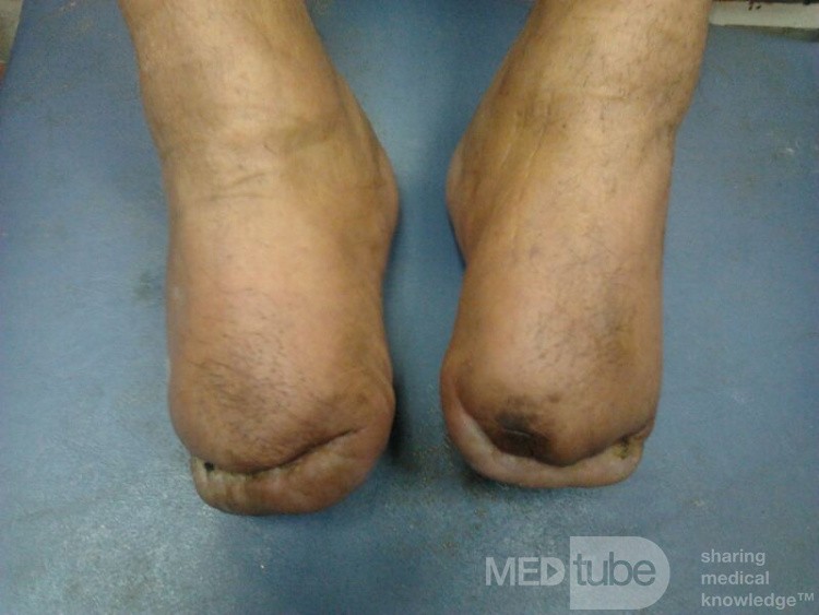Bilateral Trans Metatarsal Amputation 