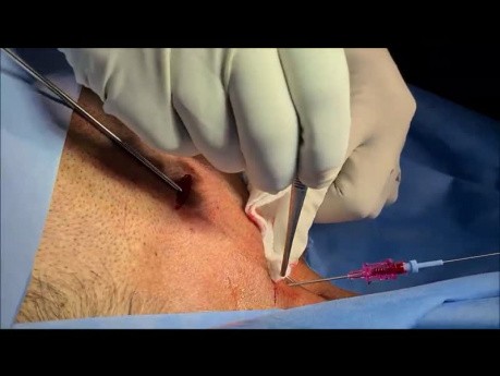 Chemoport Insertion