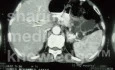 Pancreas cancer - 1