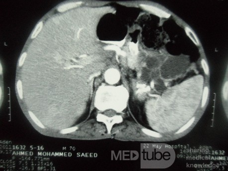 Pancreas cancer - 1