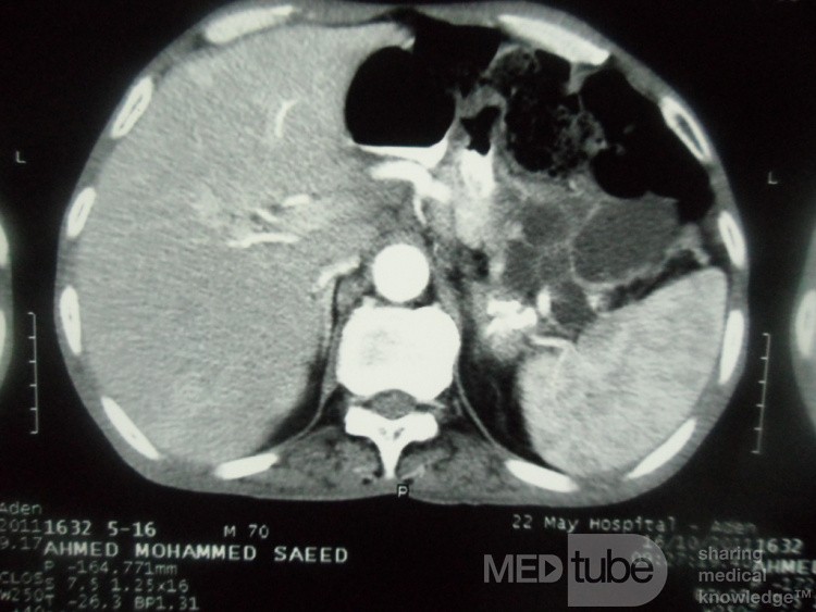 Pancreas cancer - 1
