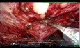 Tips and Tricks: Robot-assisted Radical Prostatectomy