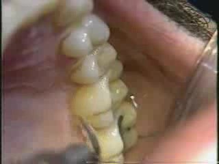 Micro Ultrasonic Teeth Celaning