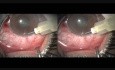 Microtrack Filtration - Bleeding After Iridectomy