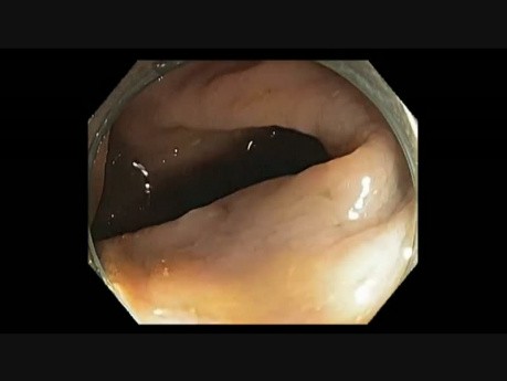 Ascending colon - Large Polyp - Failed Resection