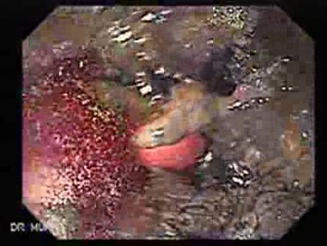 Adenocarcinoma of the Cardia and Carcinoma Epidermoid of the Larynx (24 of 26)