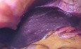 Laparoscopic gastrostomy in stentiating esophageal cancer