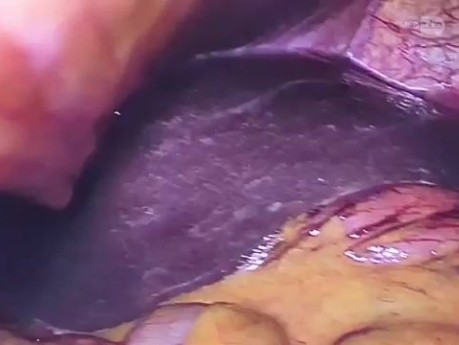 Laparoscopic gastrostomy in stentiating esophageal cancer