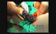 Esophagectomy - Esophageal Cancer Surgery