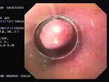 Acute Variceal Bleeding - Repeat Banding
