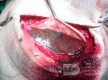 Acute Spontaneous Subdural Hemorrhage in the Subdural Space