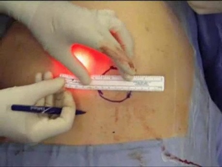 Laparoscopic repair of double hernia