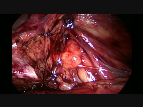 TEP for Bilateral Direct Inguinal Hernia