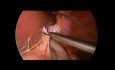 Re-do - Laparoscopic Repair of Recurrent Hiatal Hernia Using Synthetic Mesh