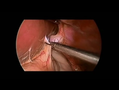 Re-do - Laparoscopic Repair of Recurrent Hiatal Hernia Using Synthetic Mesh