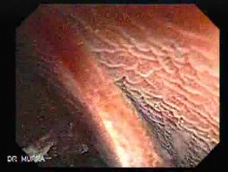 Melanosis Coli (2 of 5)