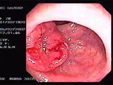 Rectal Cancer - Colonoscopy