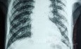 Miliary TB