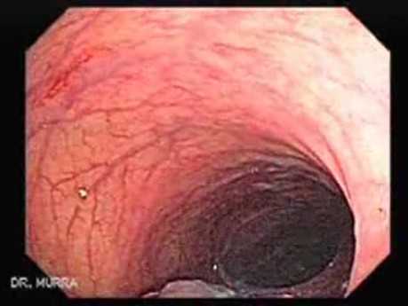 Huge Mass Of The Descending Colon (18 of 25)
