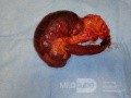 Obstructive Ileus - Right Colon Flexure Cancer