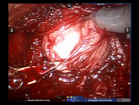 Retzius Sparing Robot Assisted Radical Prostatectomy
