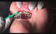 Step-by-Step Fixed Implant Dentures - Step 1: Impressions 