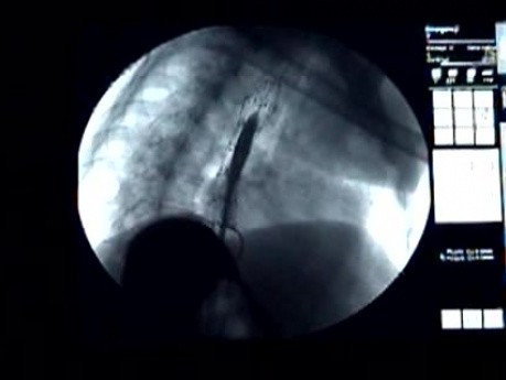 Esophageal Stenting - Fluoroscopic View