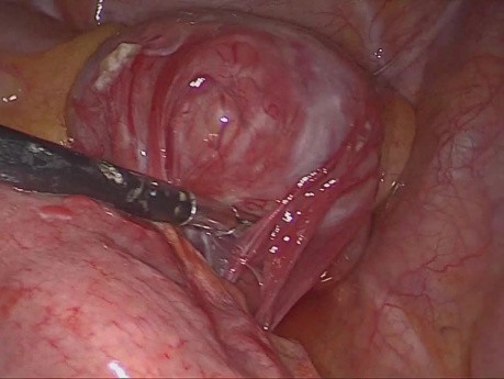 Laparoscopic Resection of Jejunal GIST